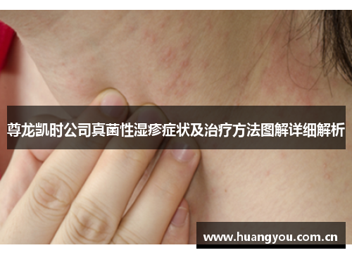 尊龙凯时公司真菌性湿疹症状及治疗方法图解详细解析